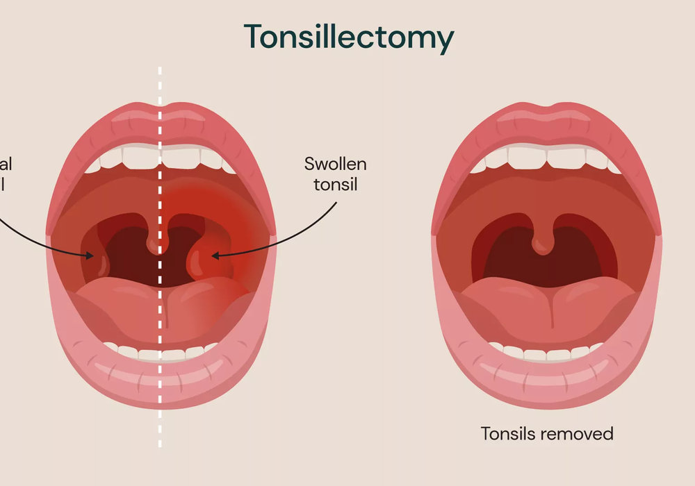 Tonsillectomy Time: When and Why Tonsils Need to Come Out