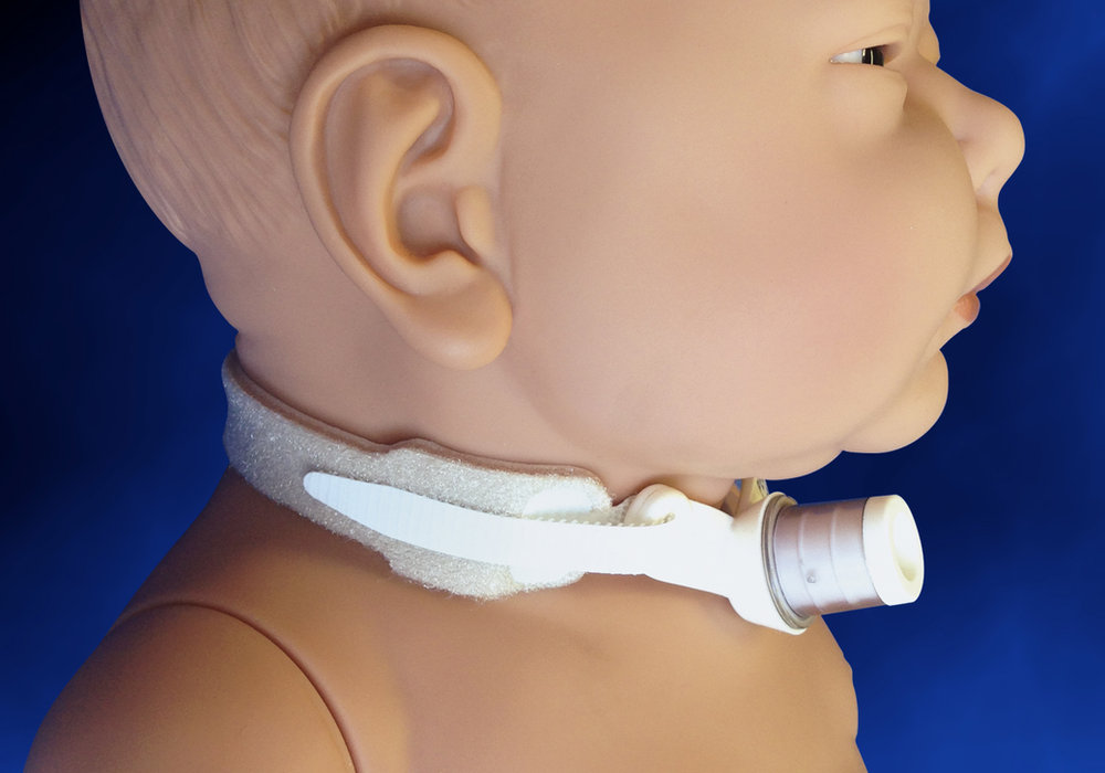 A Breath of Fresh Air: Understanding Tracheostomy Surgery in Children