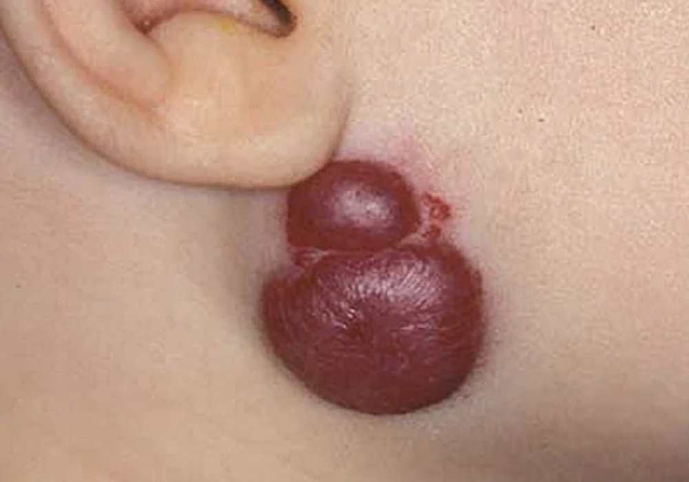 Understanding Haemangiomas: Causes, Symptoms, and Treatment Options