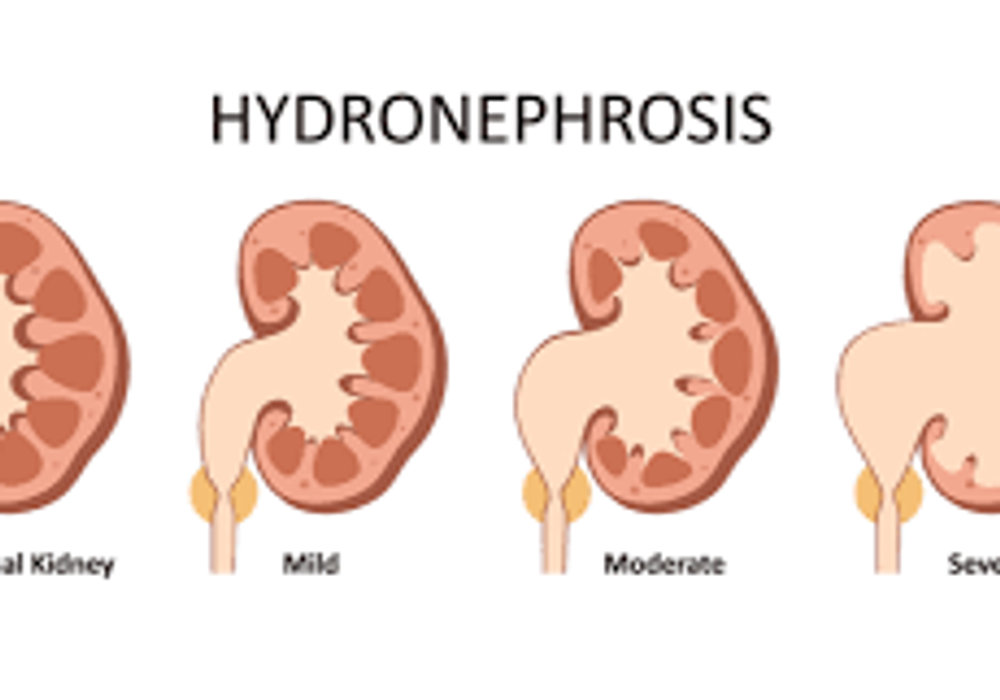Understanding Hydronephrosis: Causes, Symptoms, and Treatment Options