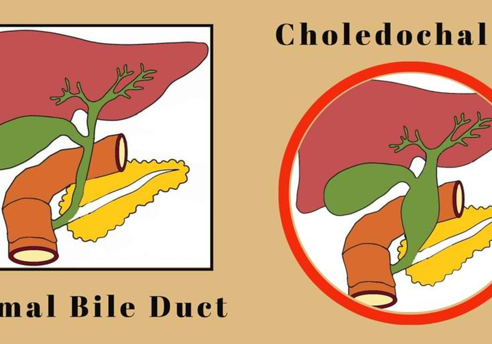 Choledochal Cyst: A Pediatric Surgical Challenge