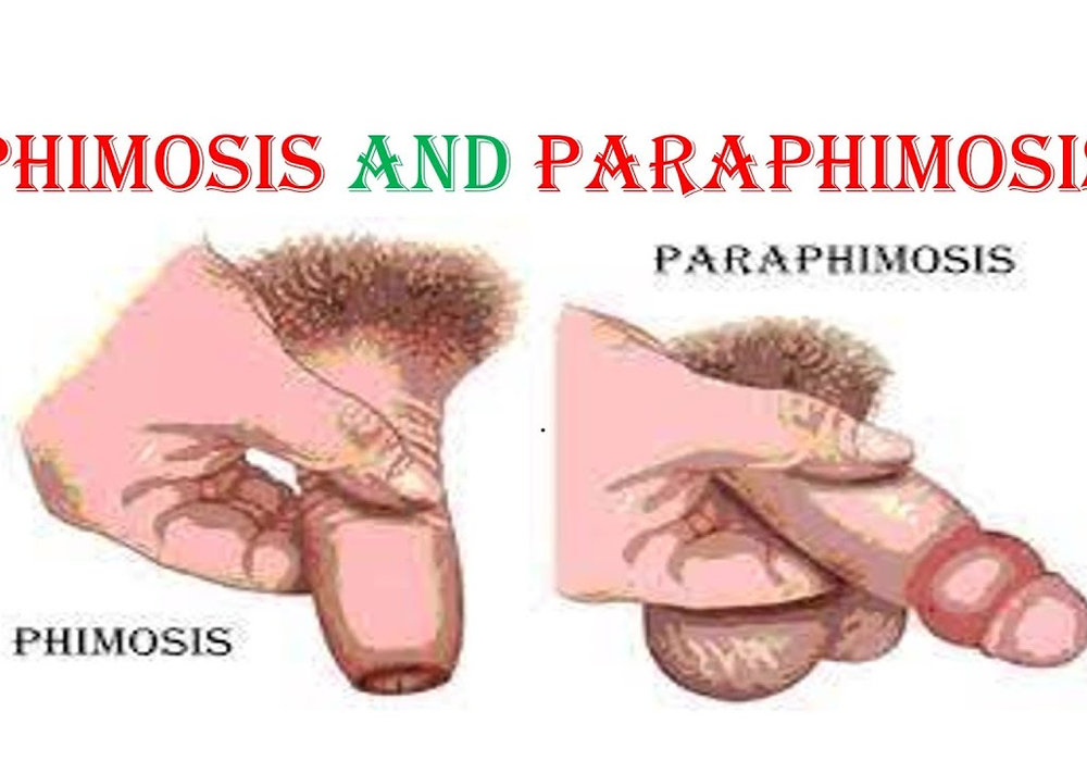Understanding Phimosis and Paraphimosis: Causes, Symptoms, and Treatment Options