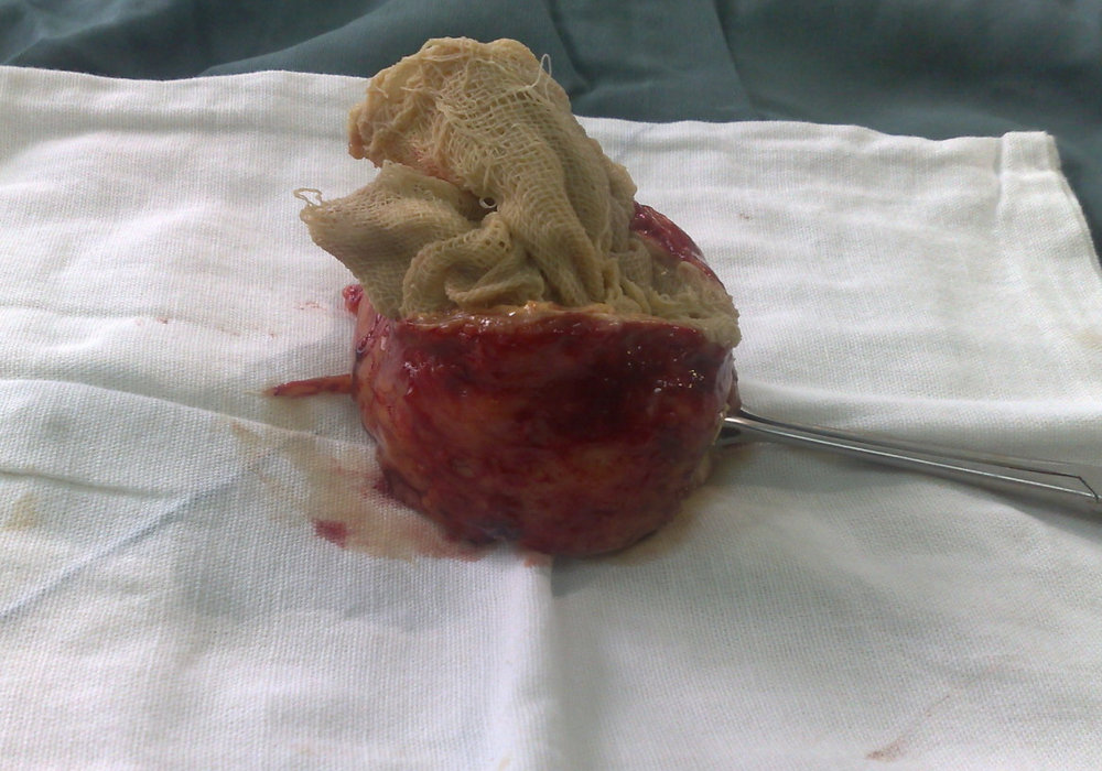 Gossypiboma: A Hidden Surgical Danger