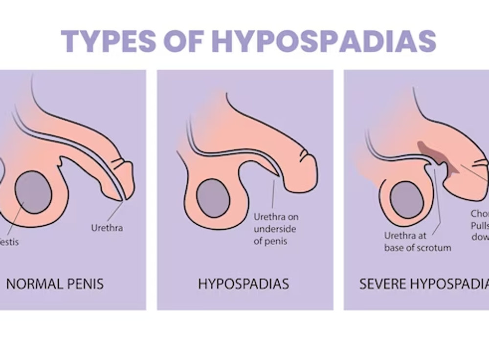Hypospadias Explained: A Guide to This Urological Condition in Boys