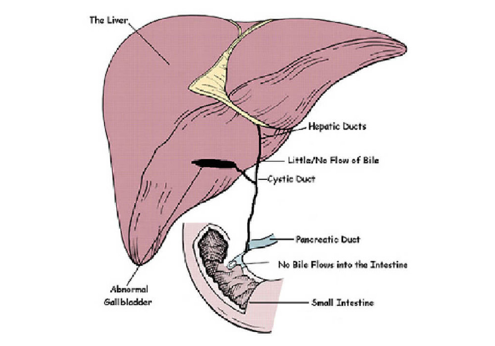 Extrahepatic Biliary Atresia (EHBA) in Children: A Comprehensive Guide