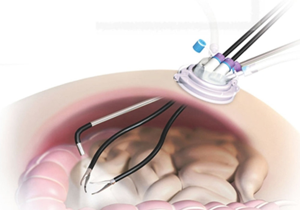 Single-Incision Laparoscopic Surgery: A Revolutionary Approach in Pediatric Care