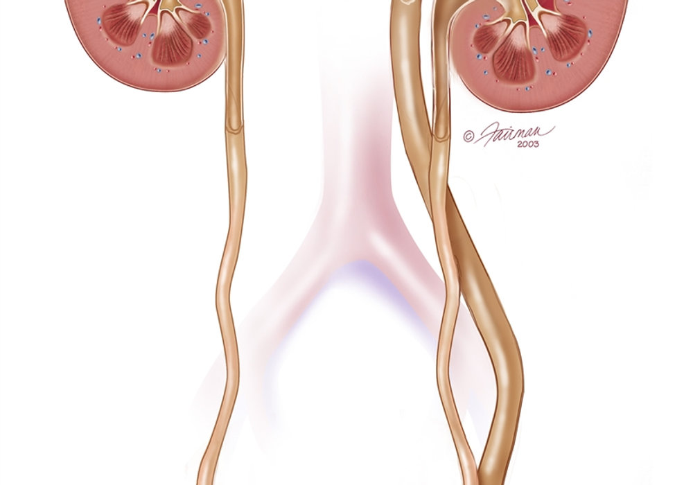 Ectopic Ureters in Children: A Hidden Challenge