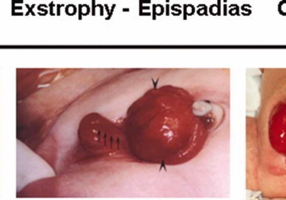 Understanding Exstrophy and Epispadias: Causes, Symptoms, and Treatment Options
