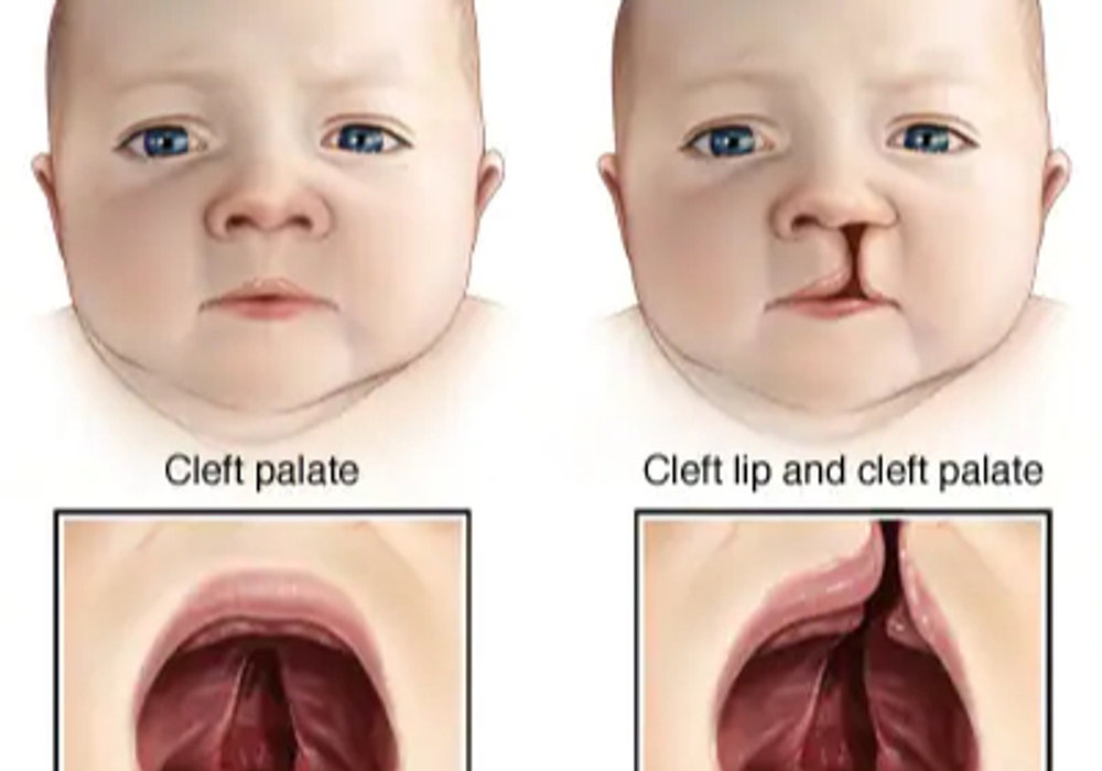 Cleft Lip and Cleft Palate: Surgical Options and Support for Children