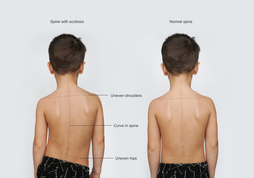 Scoliosis Solutions: Surgical Options for Spinal Curvature in Children