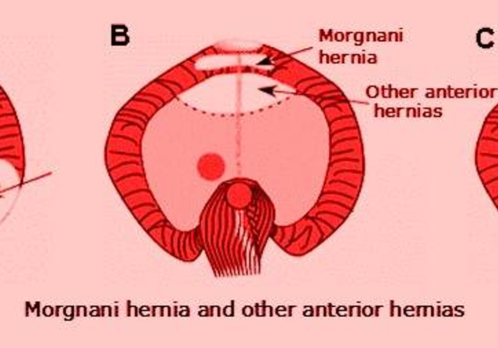 Unusual Pediatric Hernias: A Comprehensive Clinical Guide