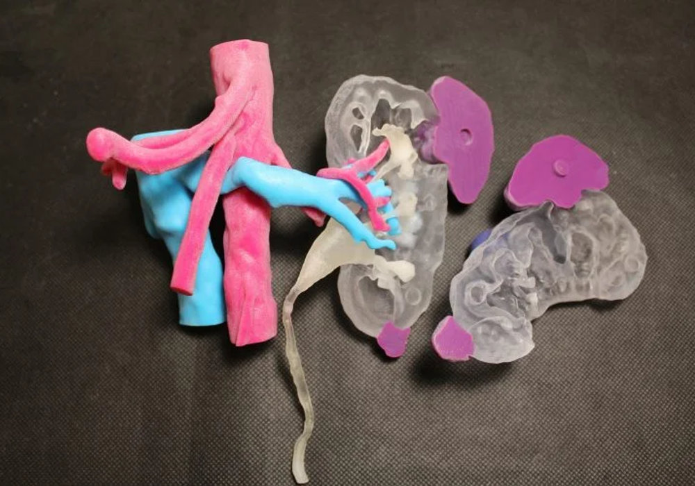 The Impact of 3D Printing Technology on Pediatric Urological Surgery: A Game Changer?