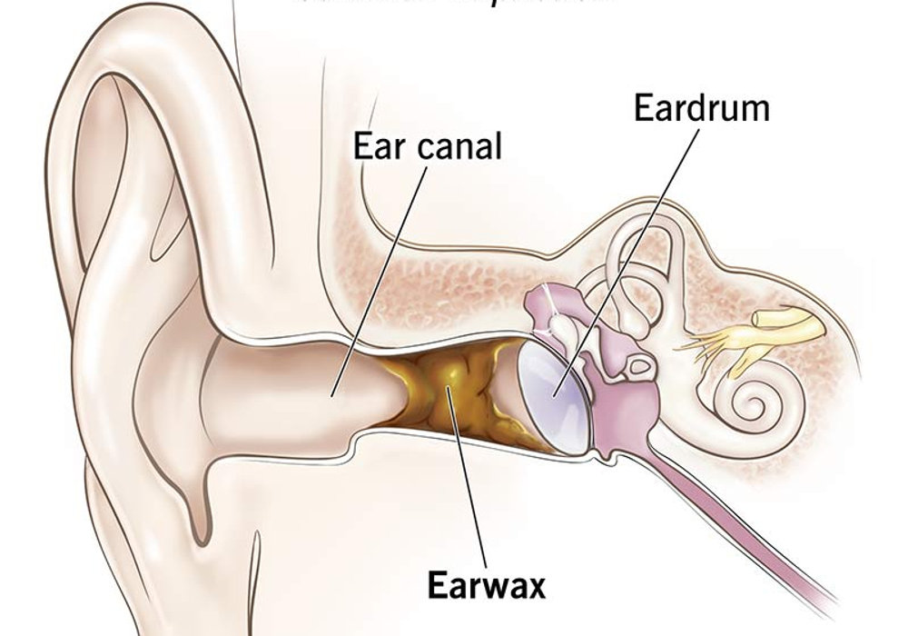 Keeping it Clear: Addressing Clogged Ear Canals with Pediatric Tube Surgery