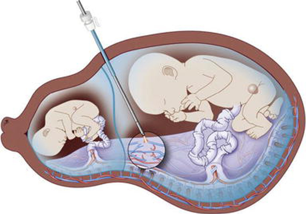 Reimagining Fetal Surgery: A Delicate Balancing Act