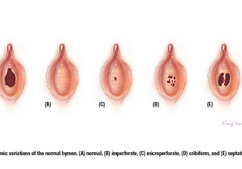 Understanding and Addressing Hymen Abnormalities: What You Need to Know