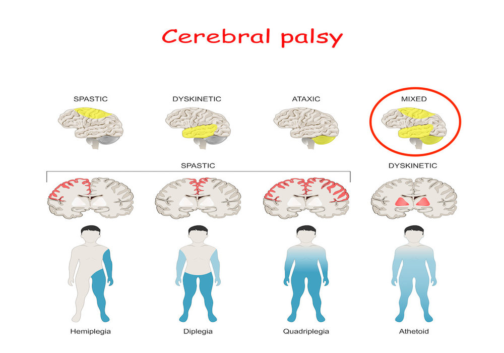 Cerebral Palsy: Understanding, Supporting, and Thriving #CerebralPalsyAwareness #CPSupport #LivingWithCP