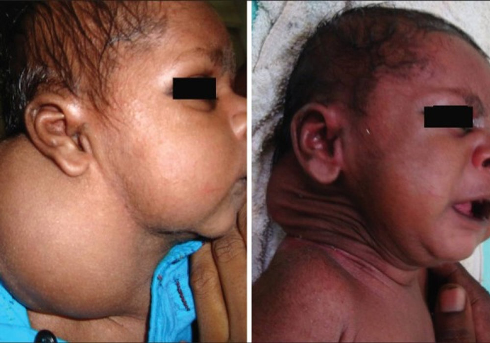 Bleomycin: A Sclerosing Agent for Lymphangiomas in Children