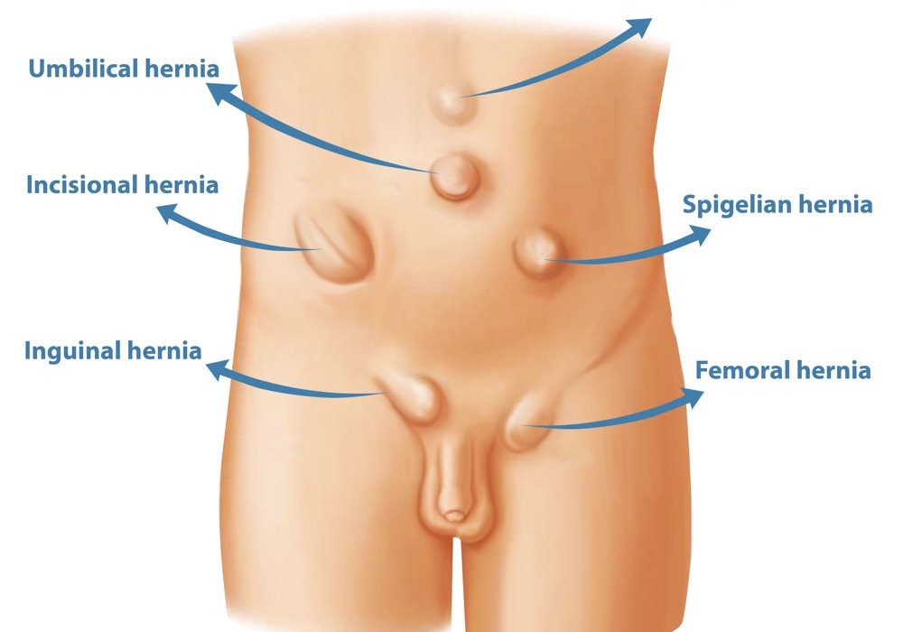 Understanding and Managing Hernias in Children: What Parents Need to Know