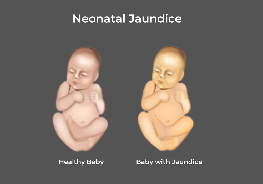 Understanding Jaundice in Children: Causes, Symptoms, and Treatment Options