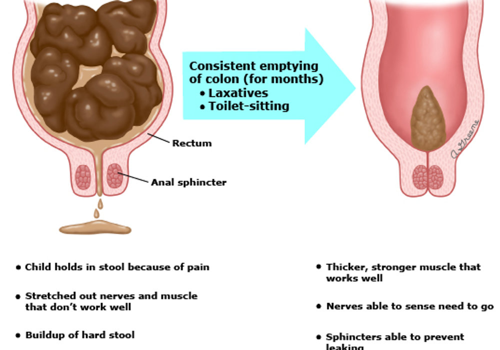 Understanding and Managing Constipation in Children: Tips and Advice for Parents