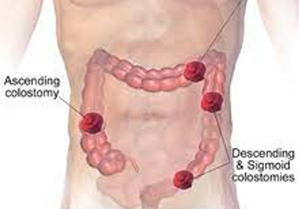 Understanding Hirschsprung's Disease: Causes, Symptoms, and Treatment Options