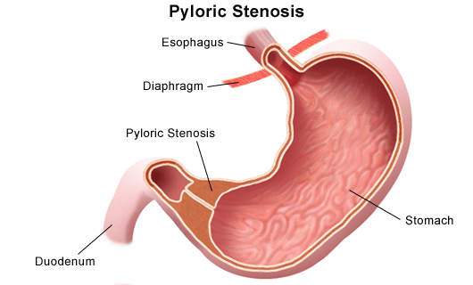 Understanding Pyloric Stenosis: Symptoms, Treatment, and Management