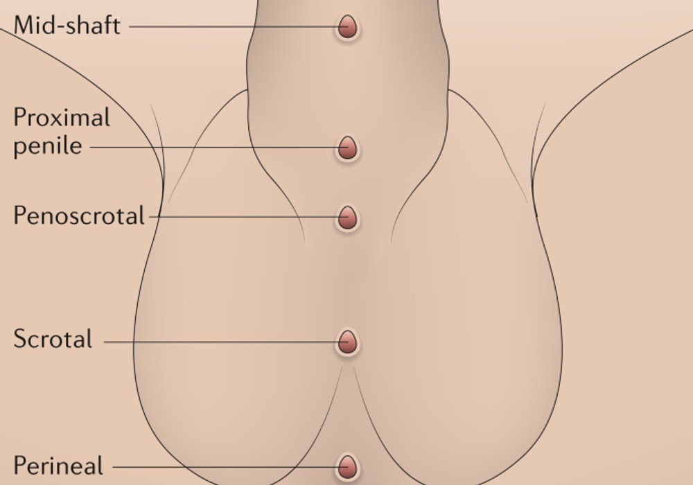 Understanding Hypospadias: Causes, Symptoms, and Treatment Options