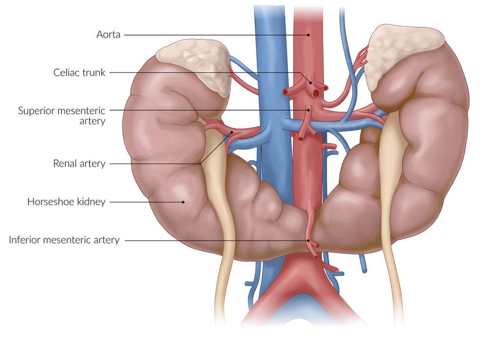 Understanding the Unique Anatomy and Health Implications of a Horse-shoe Kidney