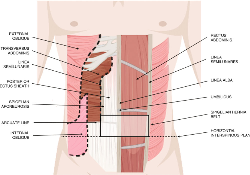 Spigelian Hernias in Children: A Rare Occurrence
