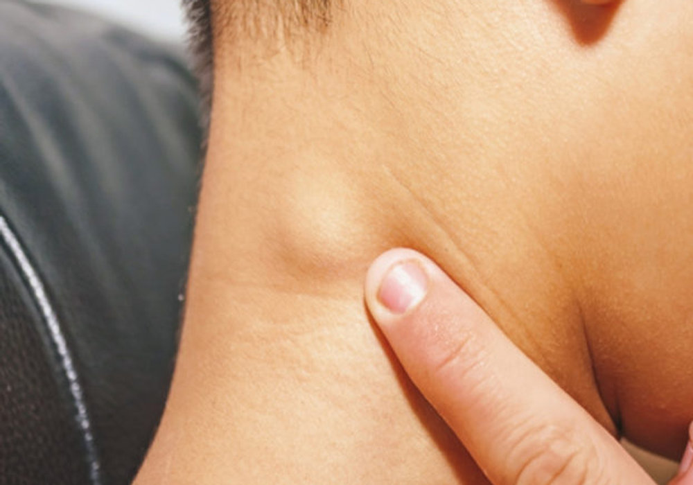 What Causes Enlarged Lymph Nodes and When to Seek Medical Attention?