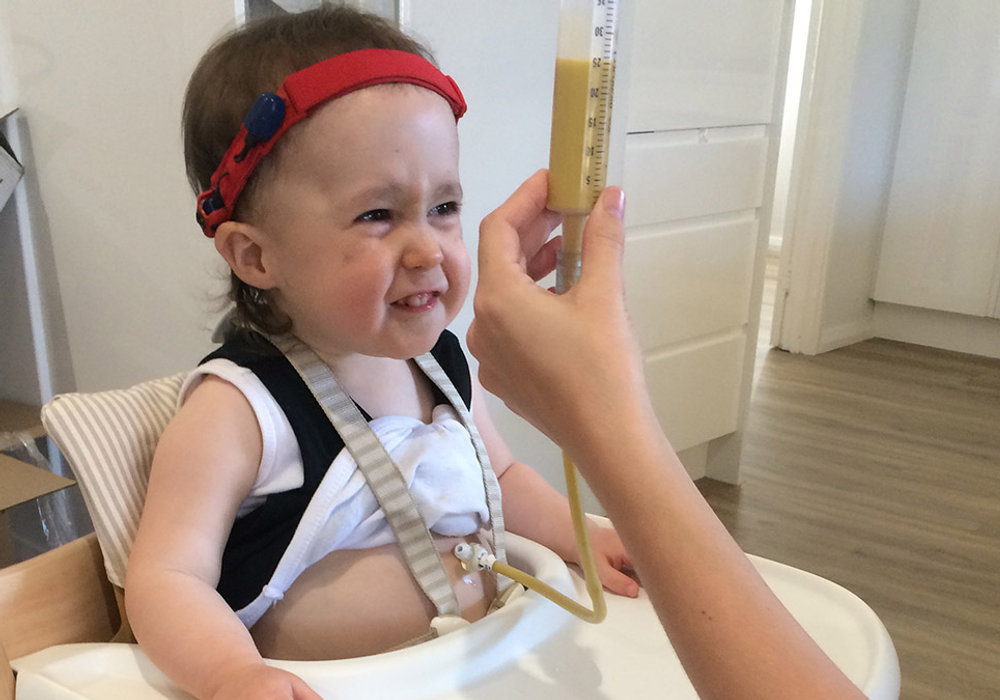 Fueling Tiny Bodies: Nutritional Considerations for Children with Feeding Tubes