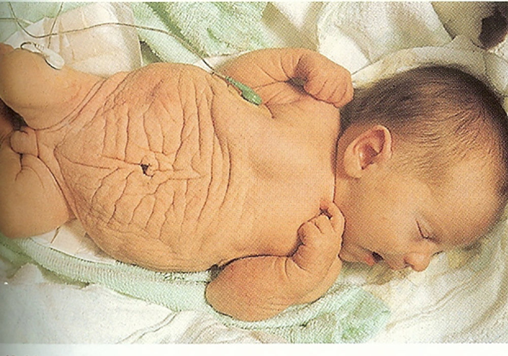 The Curious Case of Prune Belly Syndrome: A Rare Congenital Anomaly