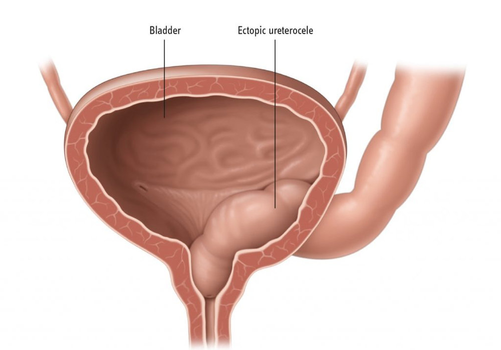 Understanding the Relationship Between Ureterocoele's and UTI's