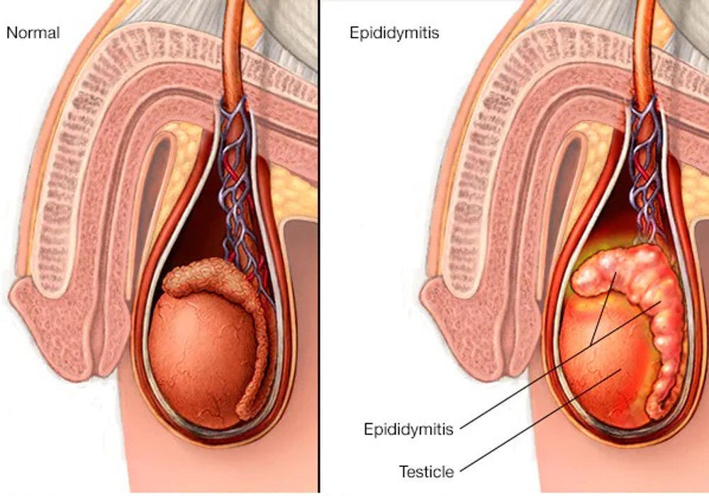 Understanding Epididymitis in Children: Causes, Symptoms, and Treatment Options