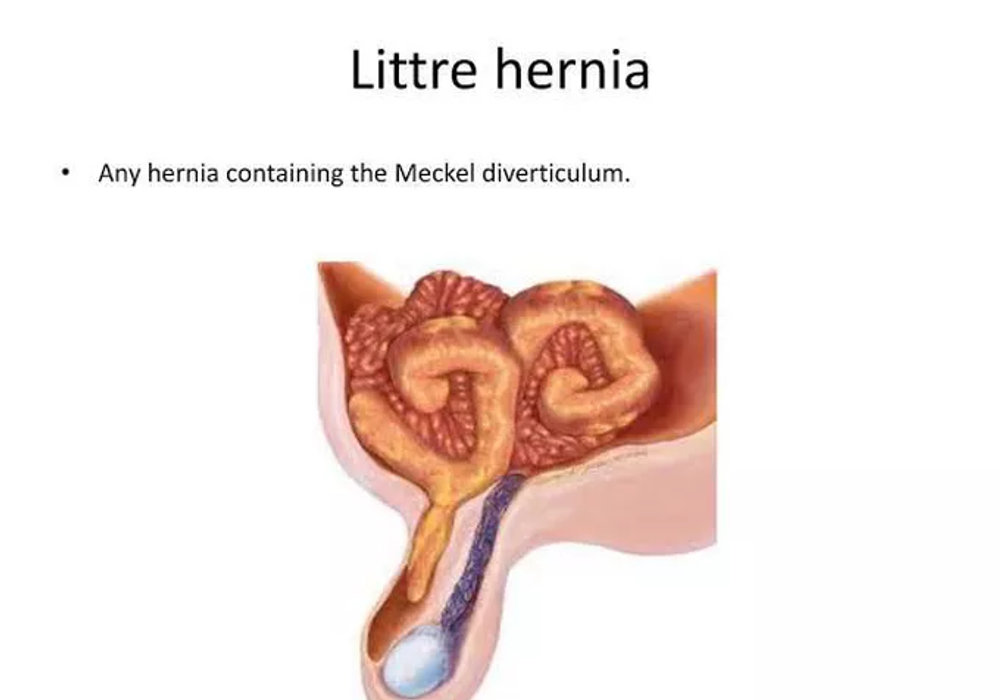 Littre and Amyand's Hernias: Rare and Fascinating Pediatric Hernia Variants