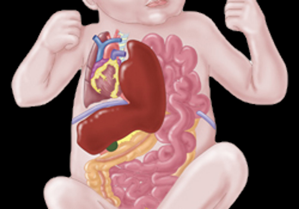 Understanding Congenital Diaphragmatic Hernia (CDH) in Pediatric Patients: Causes, Symptoms, and Treatment