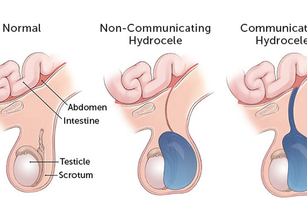 Understanding Hydrocele in Children: Causes, Symptoms, and Treatment Options