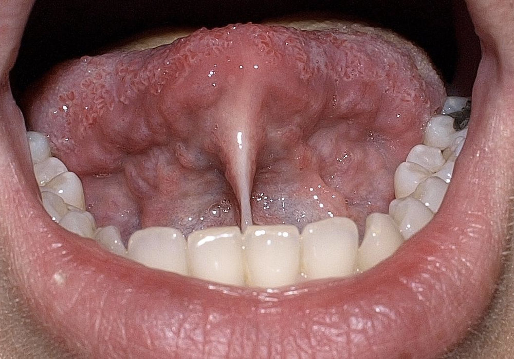 Understanding Ankyloglossia (Tongue-Tie) in Children: Causes, Symptoms, and Treatment Options