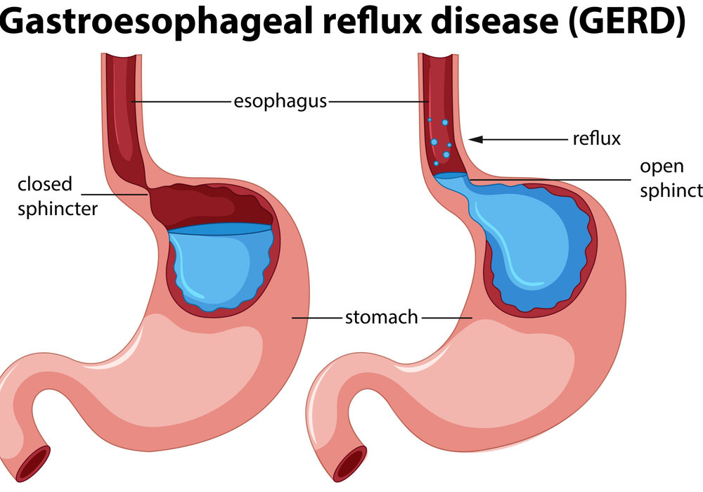 Feeding Challenges? Exploring Surgical Options for Gastroesophageal Reflux Disease (GERD) in Children