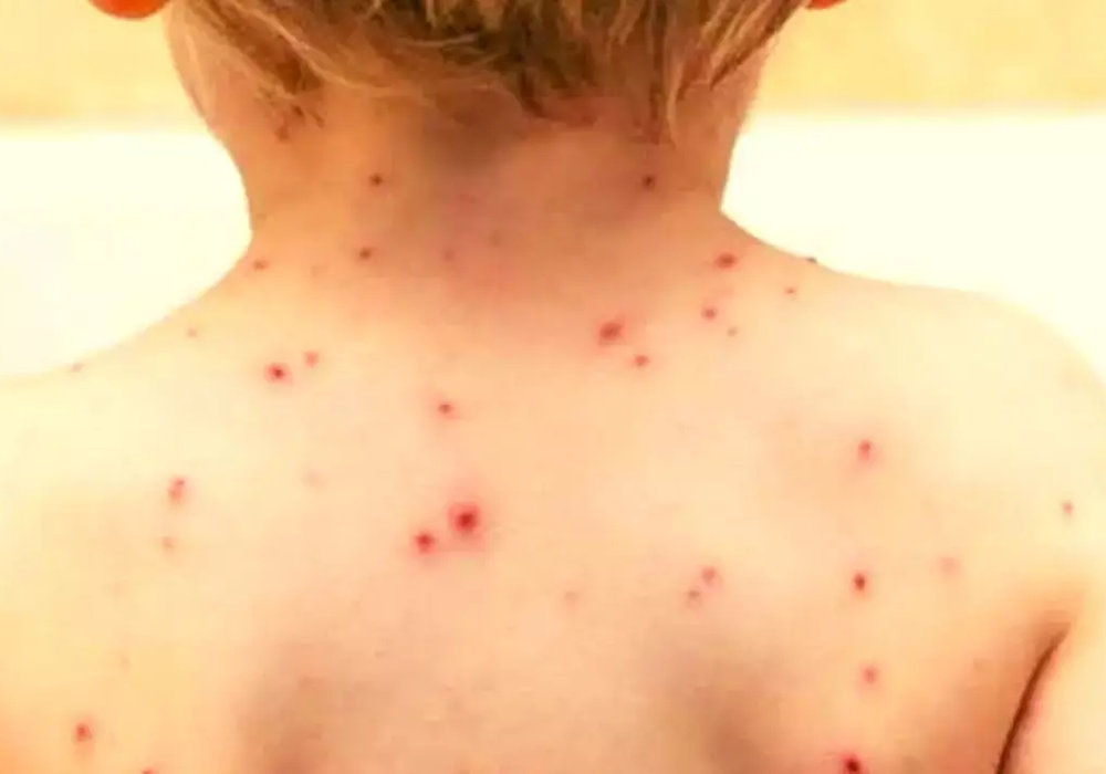 Understanding Monkeypox in Children: Symptoms, Treatment, and Prevention