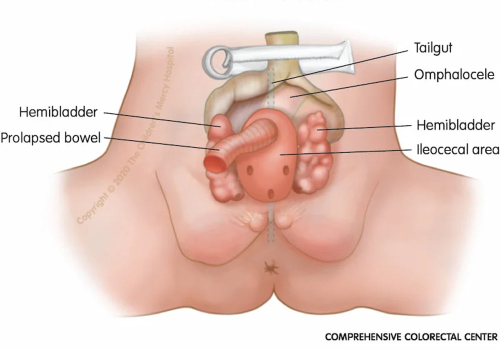 Cloacal Exstrophy: A Comprehensive Review of Current Management and Treatment Options